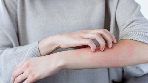 Kenali 5 Gejala Kolesterol Tinggi pada Kulit