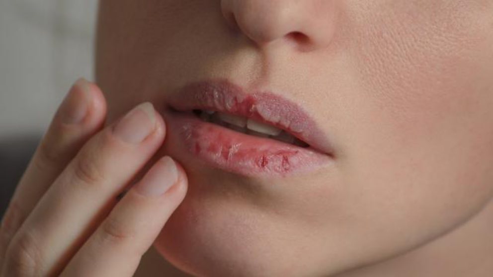 7 Cara Mengatasi Bibir Kering saat Puasa, Hindari Menjilatinya